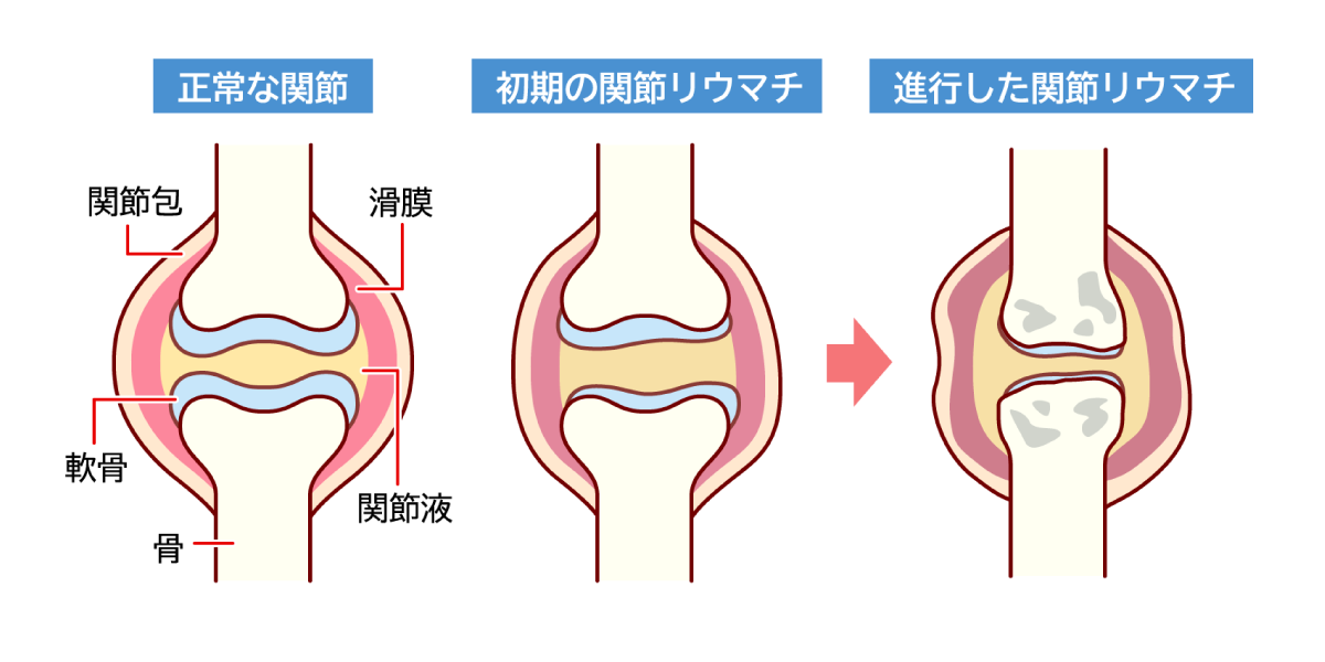 正常な関節とリウマチ